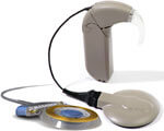 1 06 1-Фото-Implant 2. глухих, имплант, кохлеарной имплантации