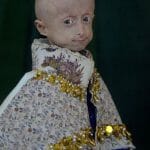 Італійський Vogue опублікував фотографії вінничанки Ірини Химич, яка хворіла рідкісним генетичним захворюванням