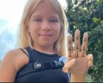Втратила руку в Бучі: 9-річна дівчинка з Гостомеля отримала унікальний протез (ВІДЕО). сша, саша філіпчук, дівчинка, протез, рука
