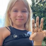 Втратила руку в Бучі: 9-річна дівчинка з Гостомеля отримала унікальний протез (ВІДЕО)