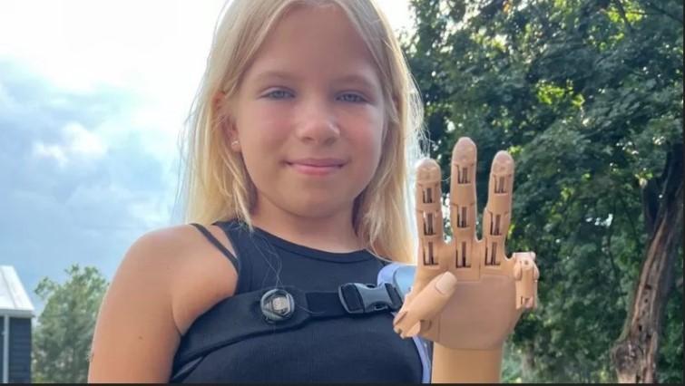 Втратила руку в Бучі: 9-річна дівчинка з Гостомеля отримала унікальний протез (ВІДЕО). сша, саша філіпчук, дівчинка, протез, рука