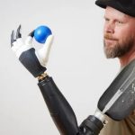 Унікальна технологія. У Швеції створили протез, який дозволяє рухати усіма пальцями окремо за допомогою нервів