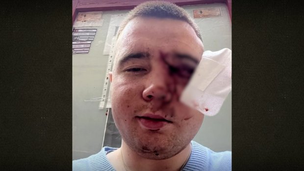 Встановив протез ока та проходить реабілітацію: як відновлюється боєць з Чернігівщини після того, як отримав поранення. костянтин ложкін, військовий, око, поранення, протез