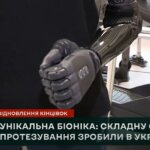 Біонічний протез: в Україні виконали складну операцію (ФОТО, ВІДЕО)