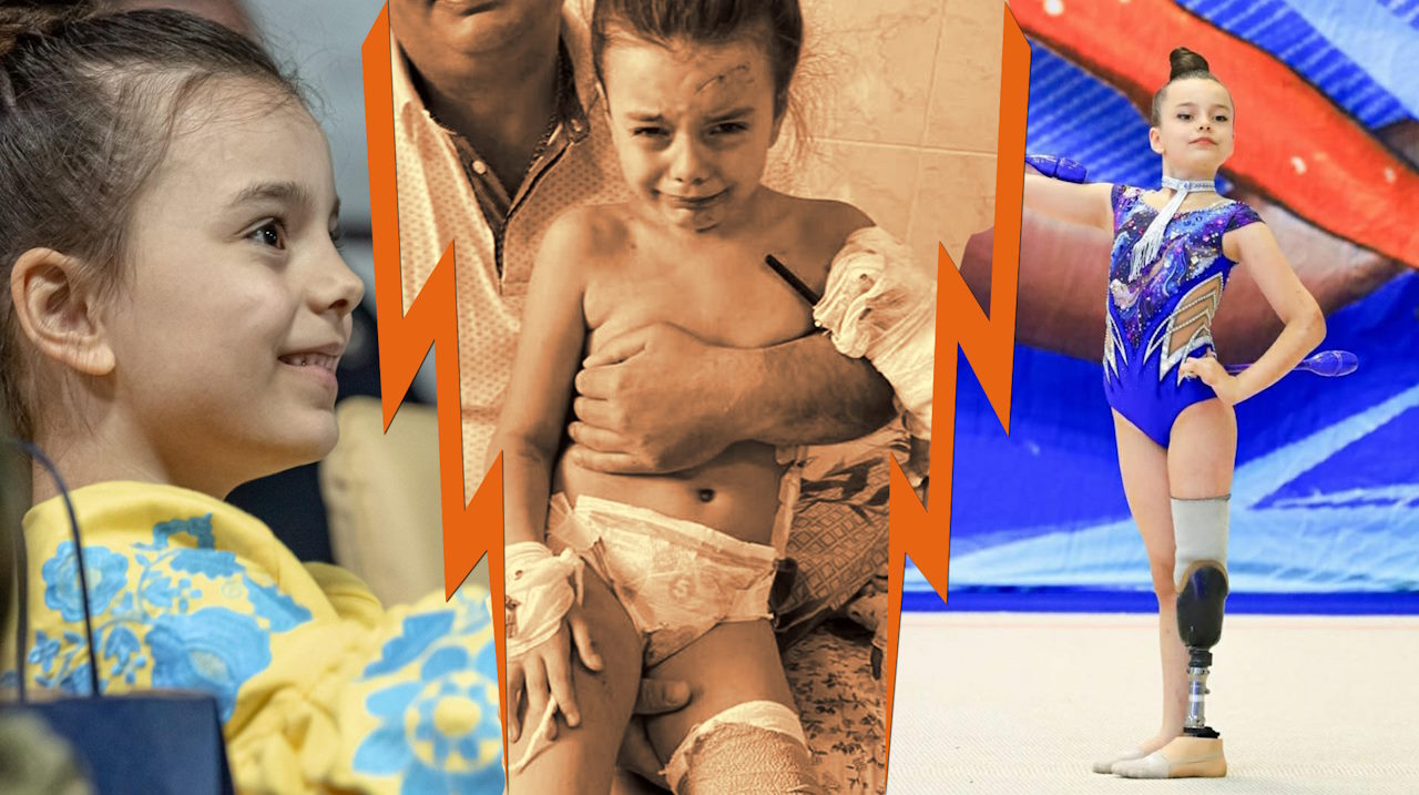 Мрію про олімпійське золото: історія 8-річної гімнастки Олександри Паскаль, яка через російську ракету втратила ногу. гімнастка, змагання, олександра паскаль, поранення, протез