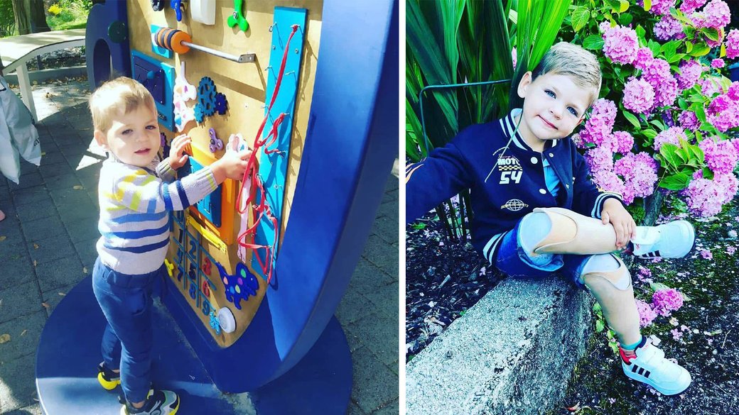 Де зараз та як справи у 5-річного Андрія Томчука, який внаслідок бомбардування Коростеня залишився без обох ніг (ФОТО). андрій томчук, бомбардування, коростень, німеччина, протез