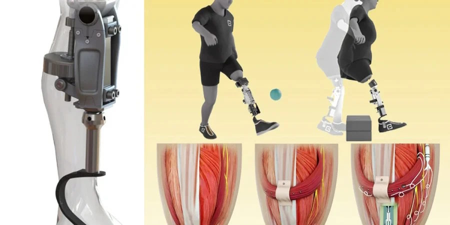 Массачусетський інститут представив унікальне біонічне коліно (ВІДЕО). e-opra, mit, біонічне коліно, пацієнт, протез