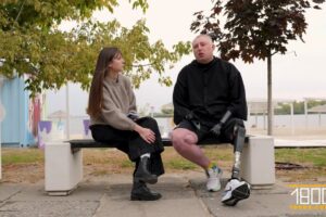 Черкасцю першому в Україні встановили остенгративні імпланти передпліччя (ВІДЕО)