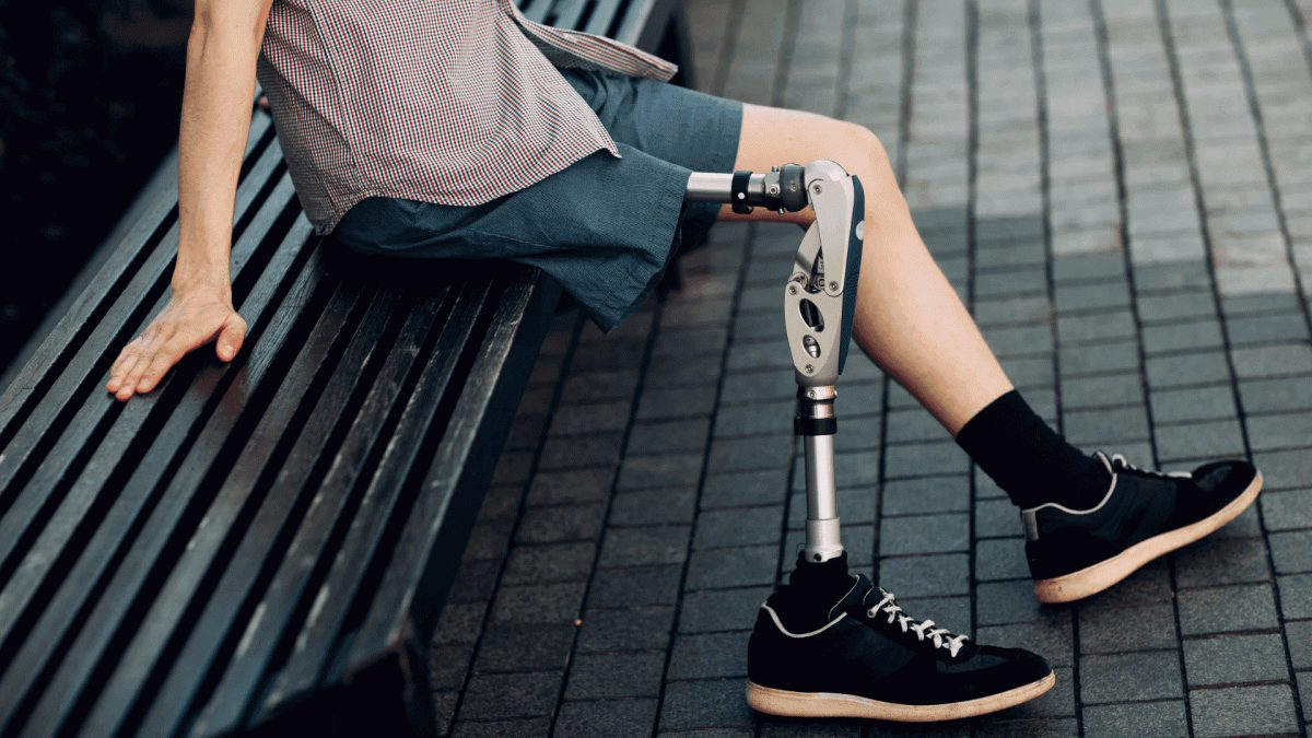 Як часто потрібно змінювати протези – поради українських спеціалістів. ампутація, заміна, корекція, пацієнт, протез