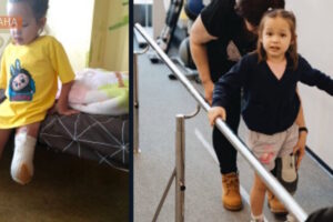 Поранена росіянами 5-річна Марійка з Дніпропетровщини вчиться ходити на протезі (ФОТО)
